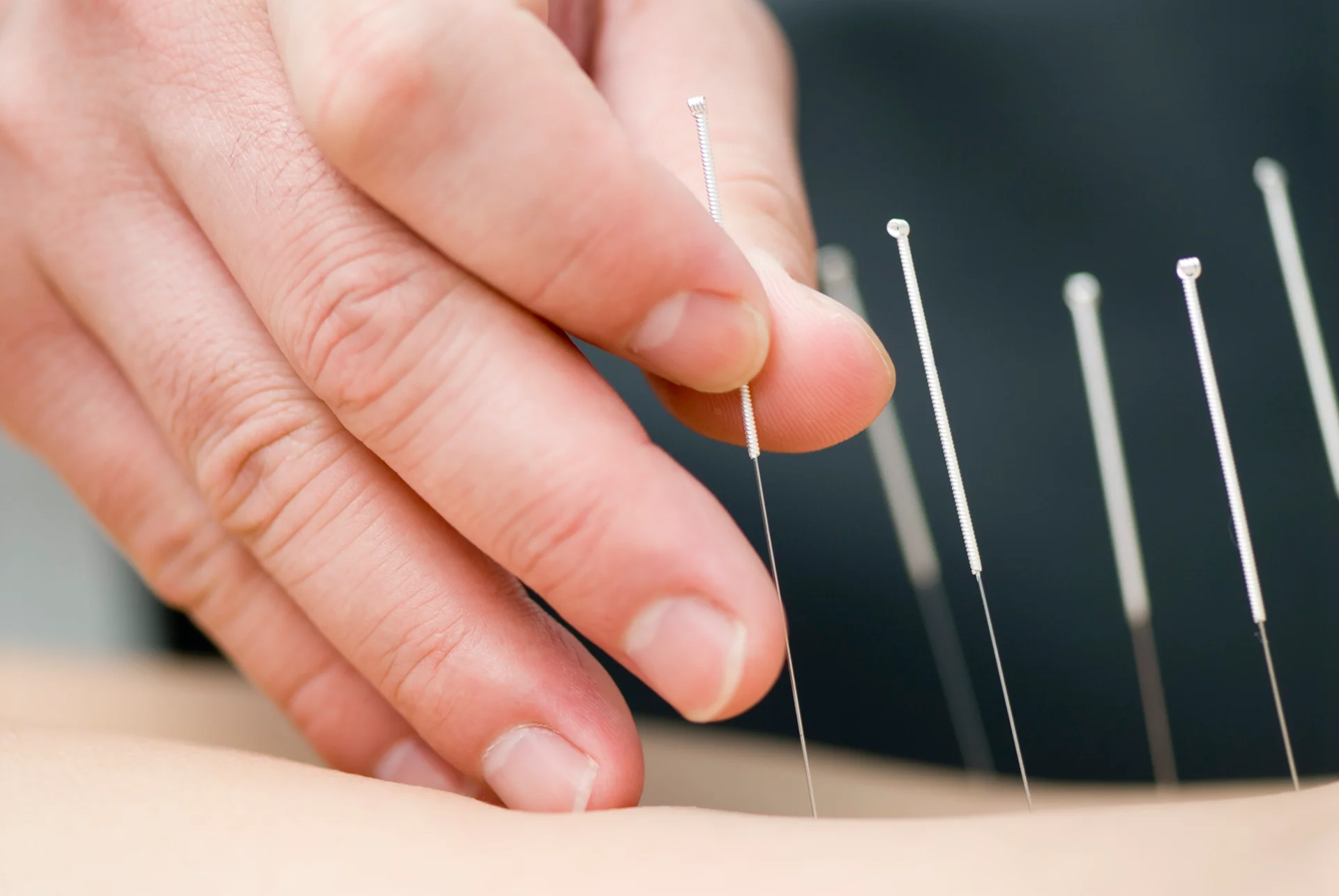 acupuncture for fertility